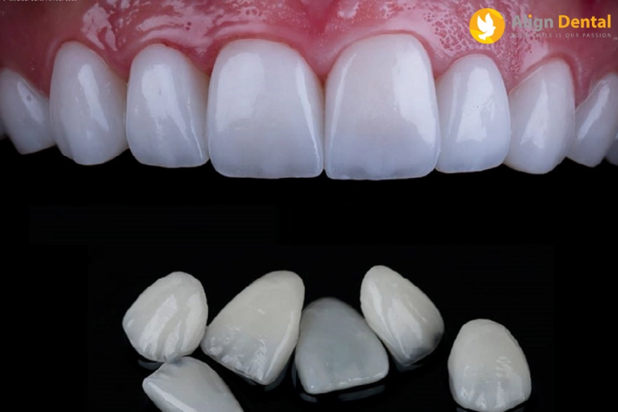 Răng sứ Veneer
