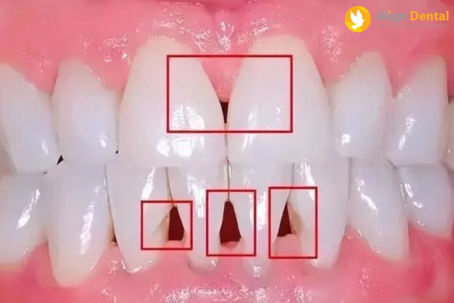 Tam Giác Đen Ở Răng Là Gì? Cách Khắc Phục Ra Sao?