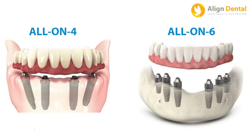 implant toàn hàm