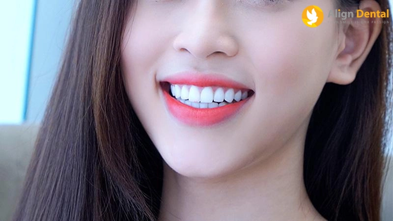cấy ghép implant xương gò má