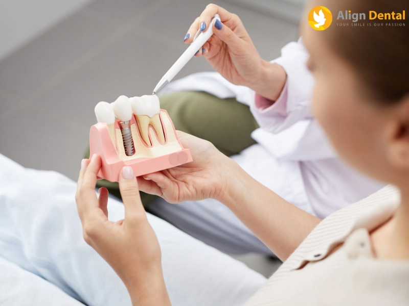 chăm sóc răng sau khi cắm implant