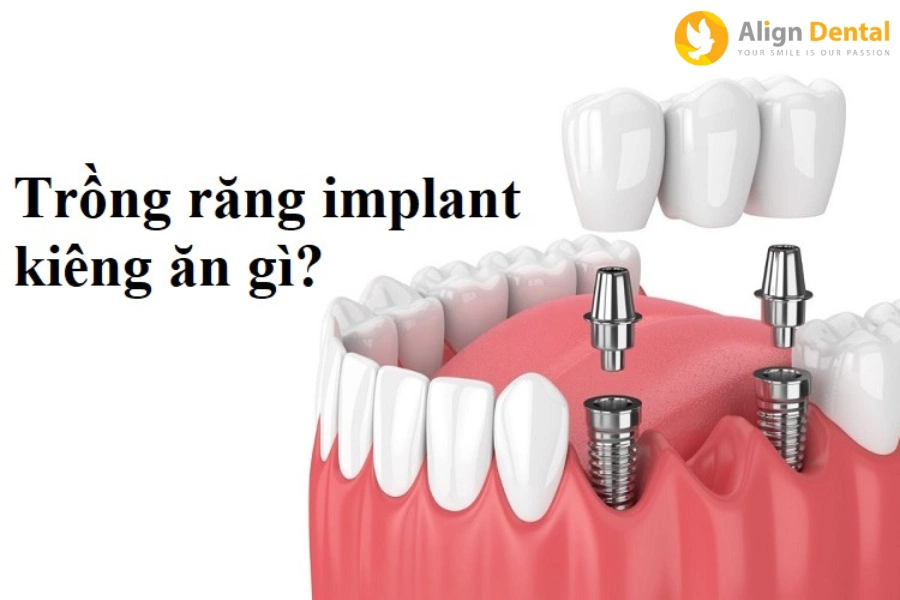Trồng Răng Implant Kiêng Ăn Gì Để Đạt Được Hiệu Quả Tốt Nhất