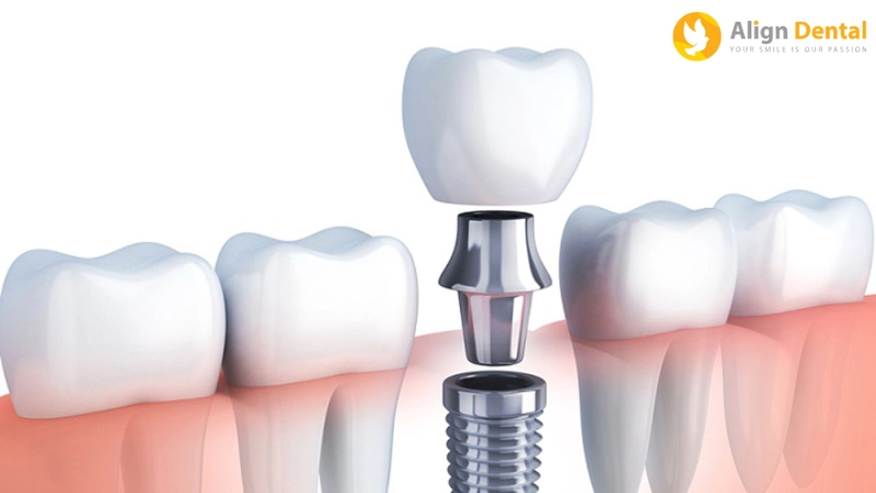 phục hình răng sứ trên implant