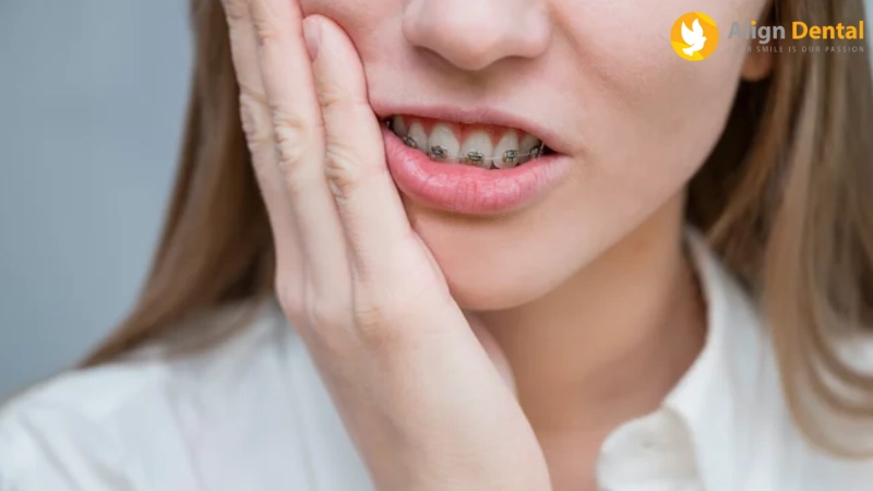 niềng răng có đau không