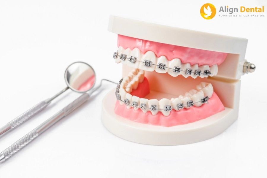 Quá Trình Niềng Răng Diễn Ra Như Thế Nào? Bao Gồm Mấy Bước?