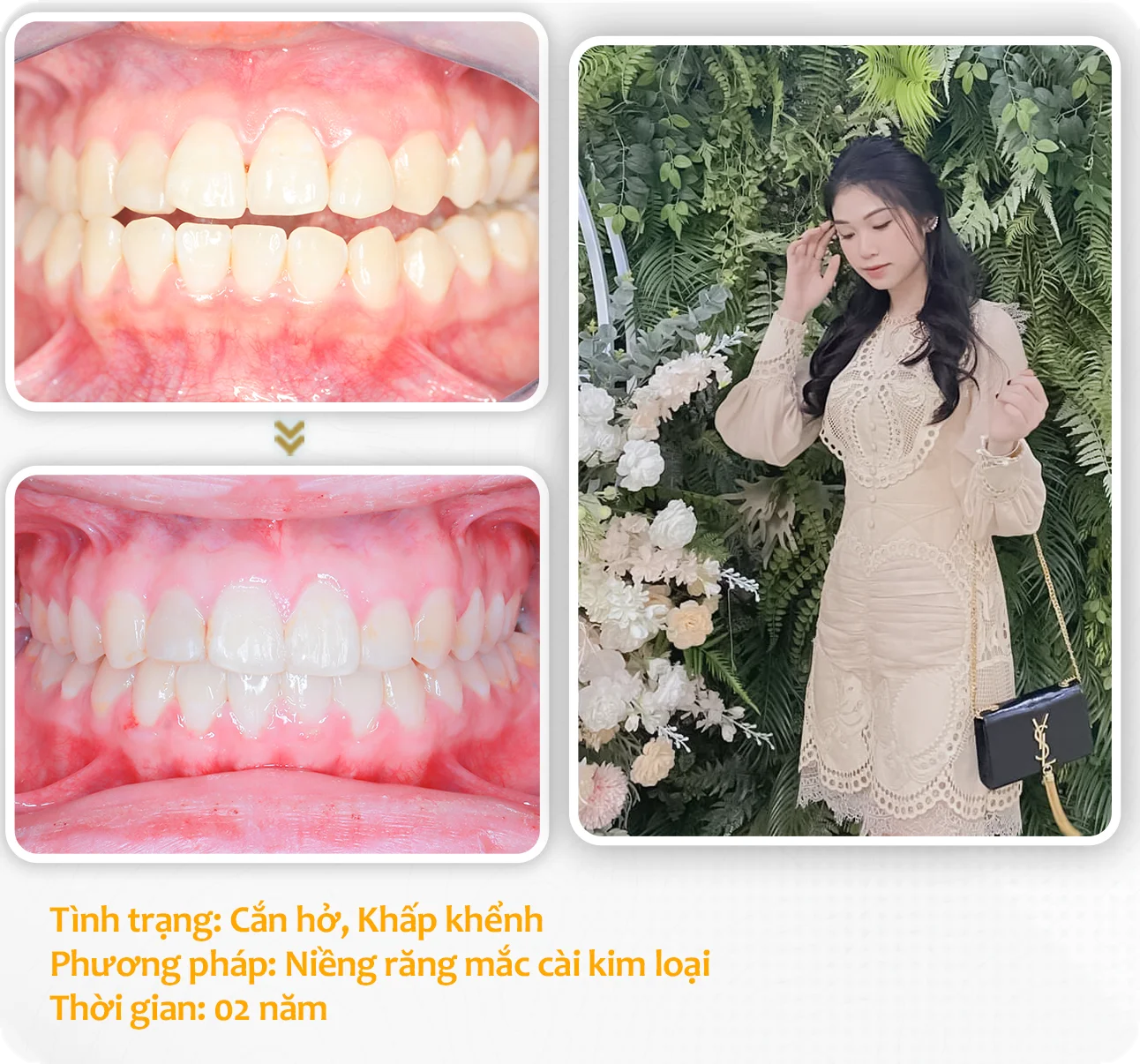 aligndental