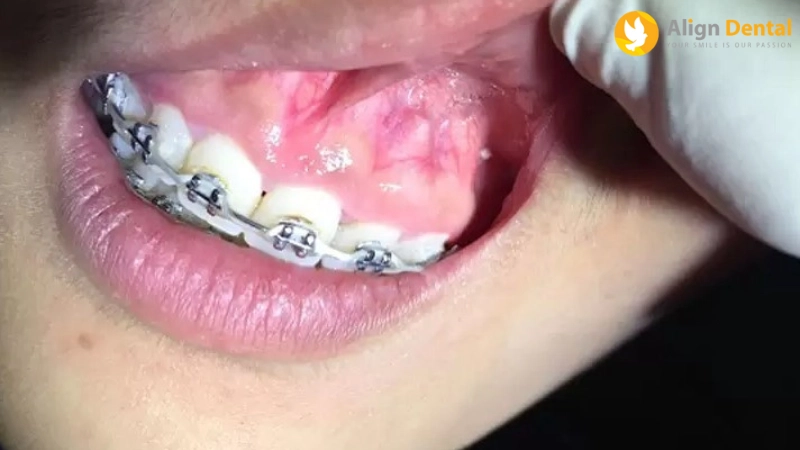 dấu hiệu niềng răng hỏng