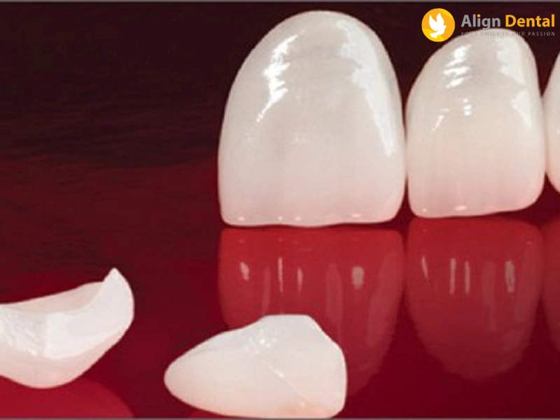 dán sứ veneer