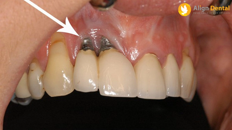 viêm quanh implant