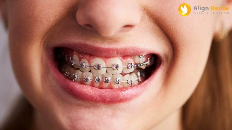 dấu hiệu niềng răng hỏng