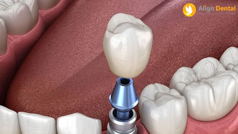 phục hình răng sứ trên implant