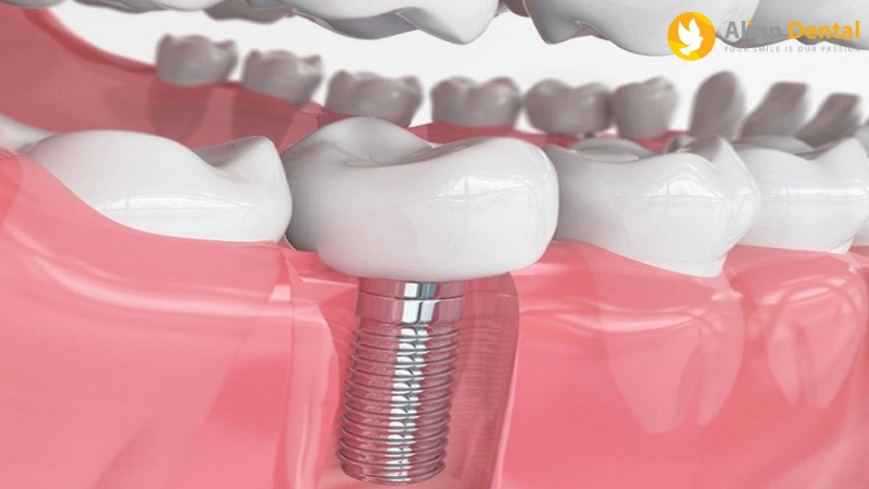 nhổ răng bao lâu thì trồng lại được