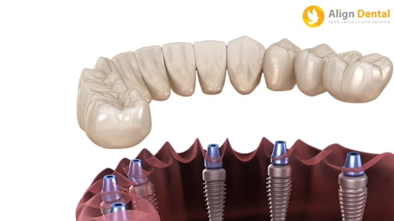 trồng răng implant