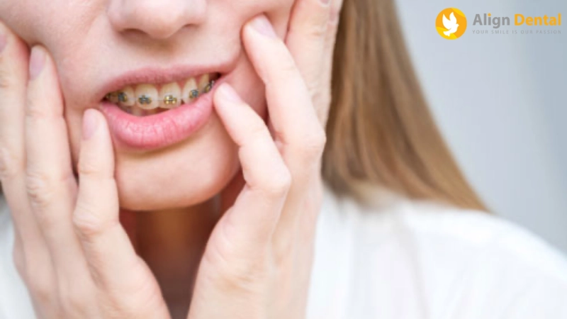 niềng răng bị hóp má