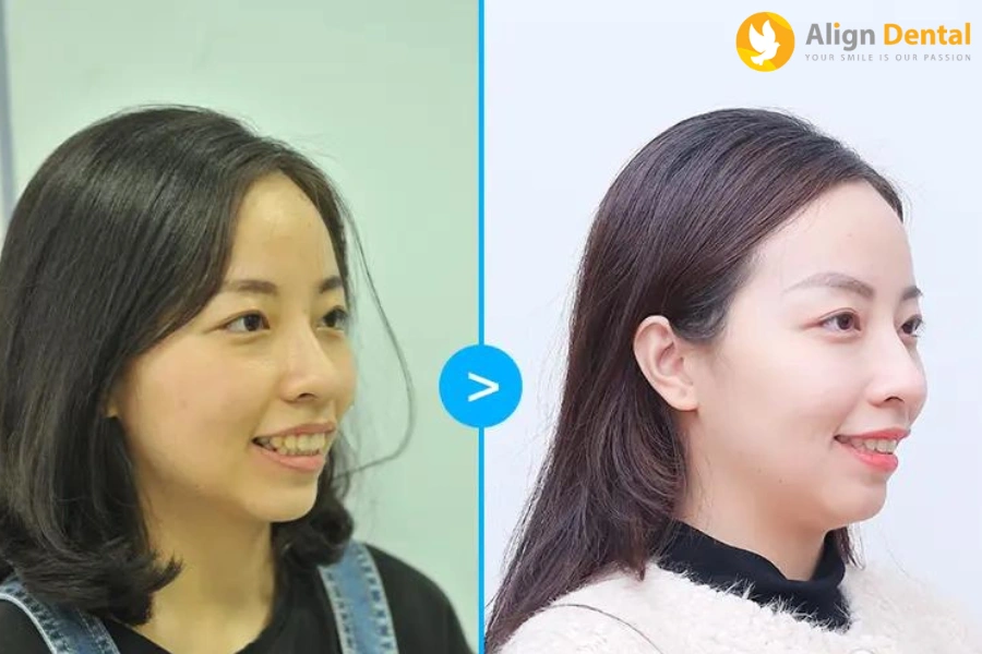 Khuôn Mặt Trước Và Sau Khi Niềng Răng Hô Thay Đổi Ra Sao?