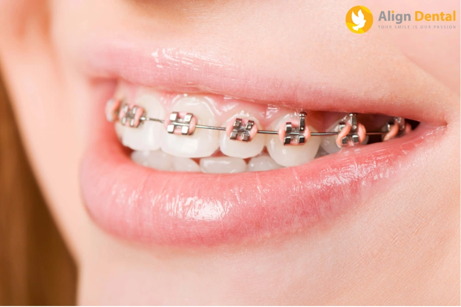 Niềng Răng Mất Bao Lâu? Yếu Tố Ảnh Hưởng Đến Thời Gian Niềng