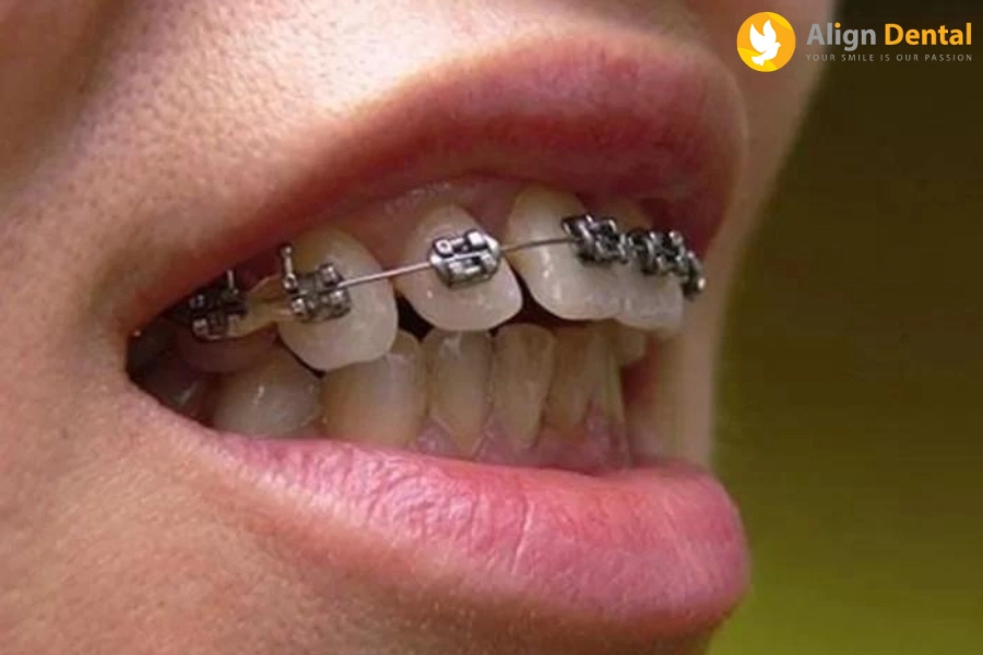 Niềng Răng Hô Và Các Phương Pháp Niềng Răng Hô Hiệu Quả Nhất