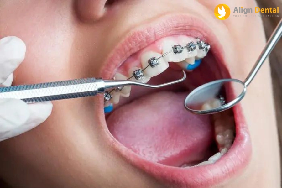 [Hỏi - Đáp] Niềng Răng Bao Lâu Tái Khám Một Lần?