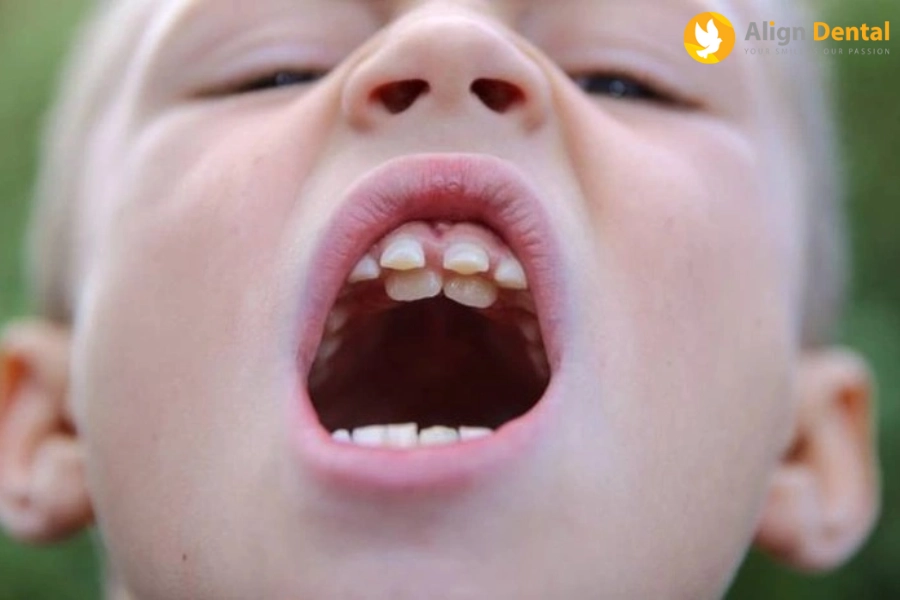 Răng Dị Dạng Là Gì? Hướng Xử Lý Răng Dị Dạng Là Gì?