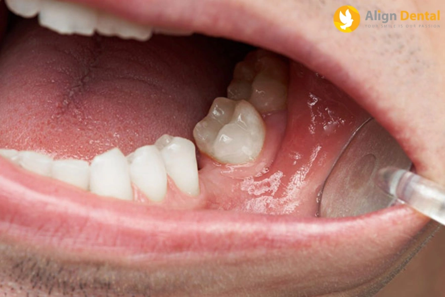 Mất Răng Lâu Năm Có Trồng Được Không? Phương Pháp Nào Tối Ưu Nhất?