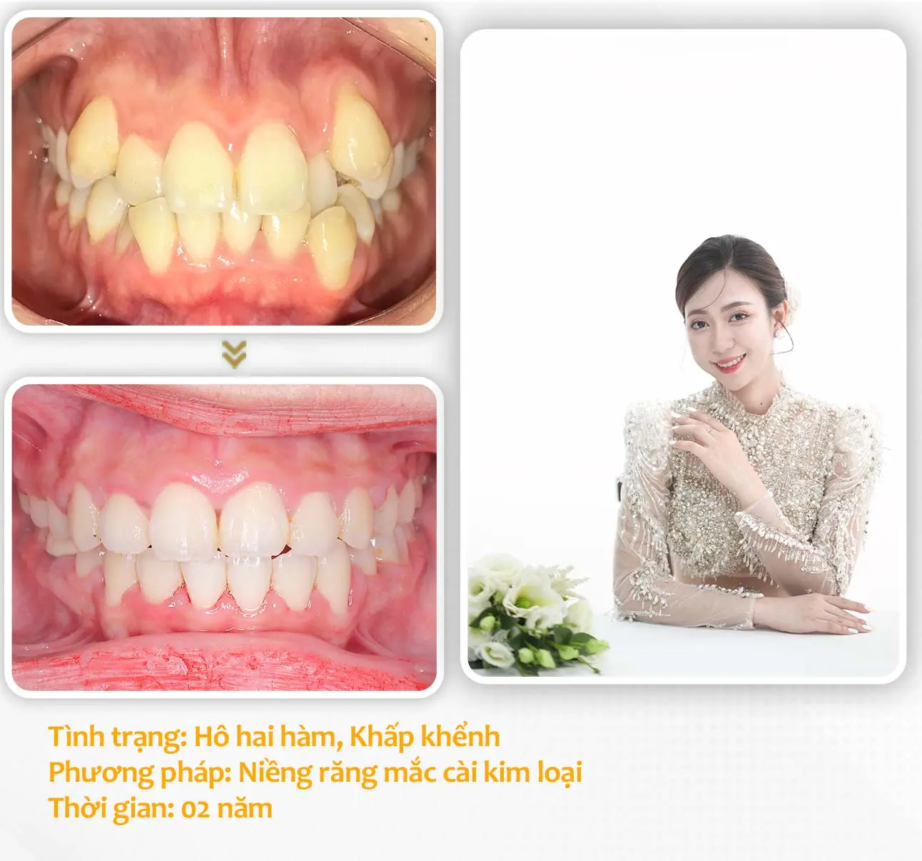 aligndental