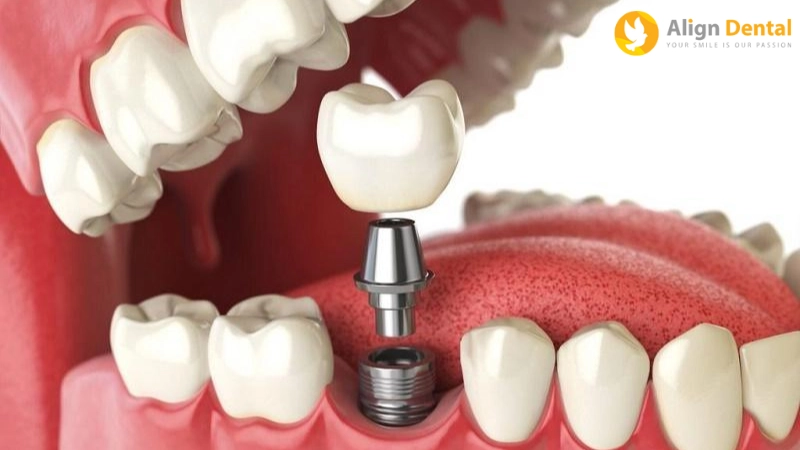 mất răng lâu năm có trồng được không