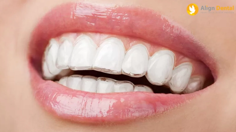 giá niềng răng trong suốt
