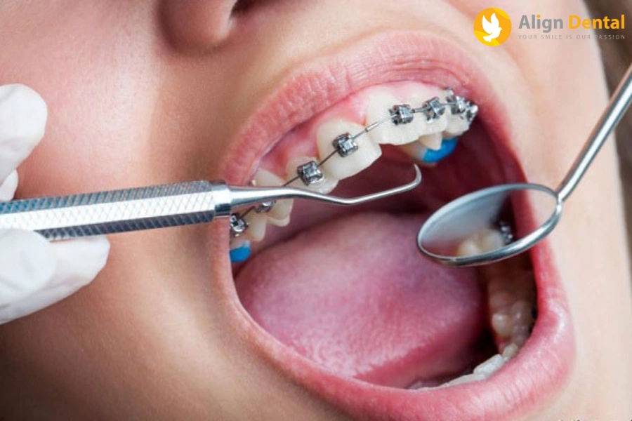 Có Nên Niềng Răng Không? Những Trường Hợp Nào Nên Niềng Răng
