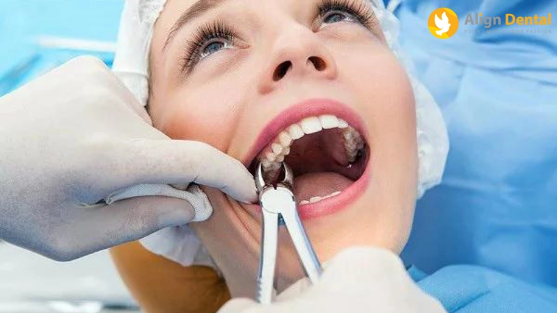 nhổ răng bao lâu thì trồng lại được