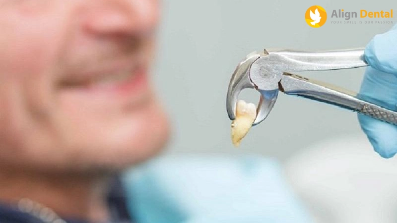 nhổ răng bao lâu thì trồng lại được