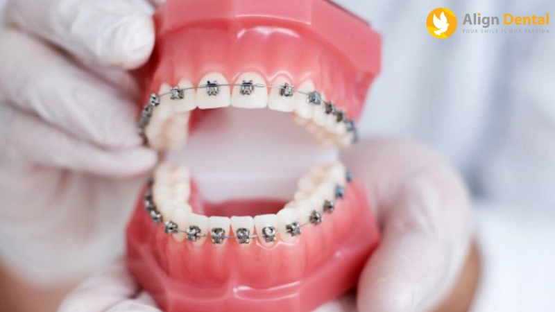 các loại niềng răng
