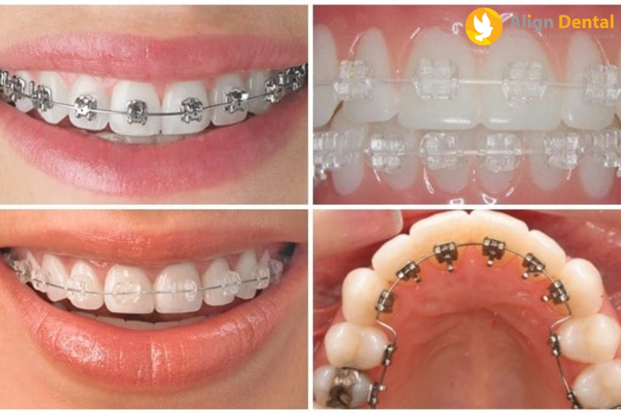Tìm Hiểu Các Loại Niềng Răng Và Ưu, Nhược Điểm Của Từng Loại