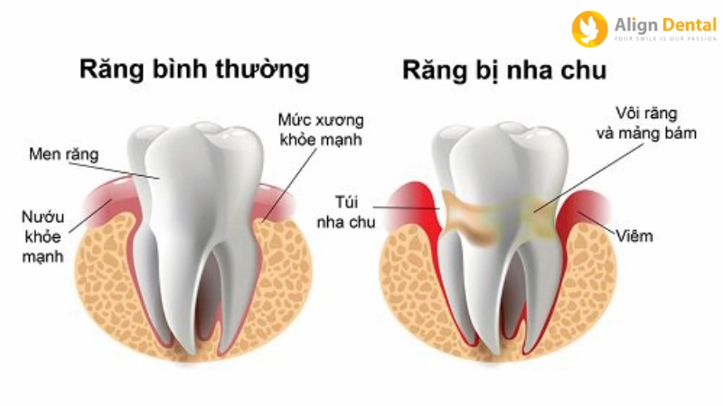 viêm nha chu
