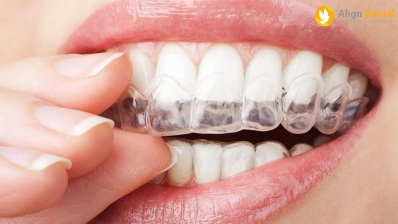 giá niềng răng trong suốt