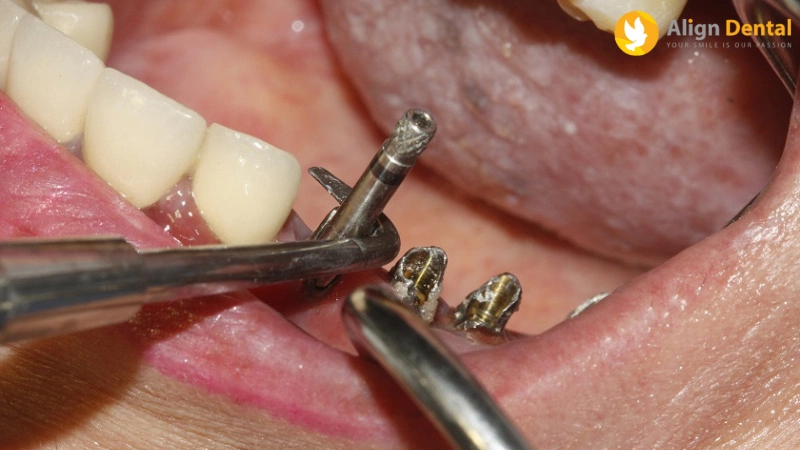 phục hình răng sứ trên implant