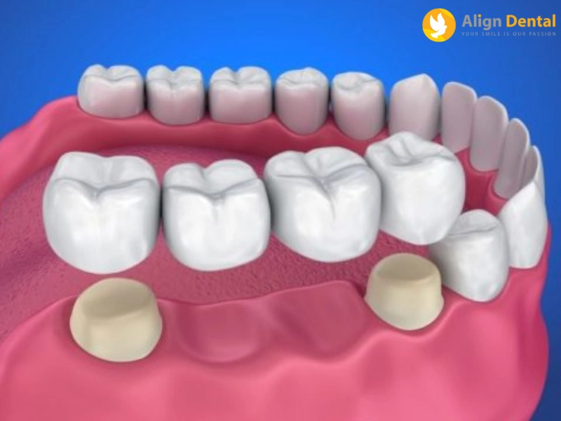 mất nhiều răng phải làm sao
