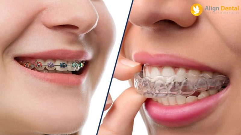 giá niềng răng trong suốt