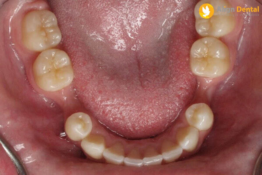 Tiêu Xương Hàm Có Trồng Răng Được Không? Vai Trò Của Xương Hàm Khi Trồng Răng