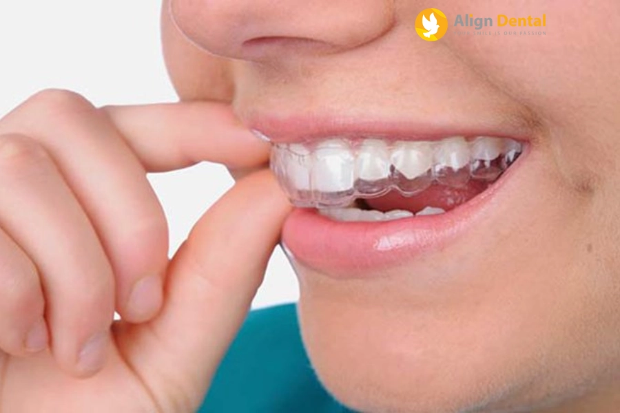 [Hỏi - Đáp] Niềng Răng Có Hết Cằm Lẹm Không? Phương Pháp Xử Lý