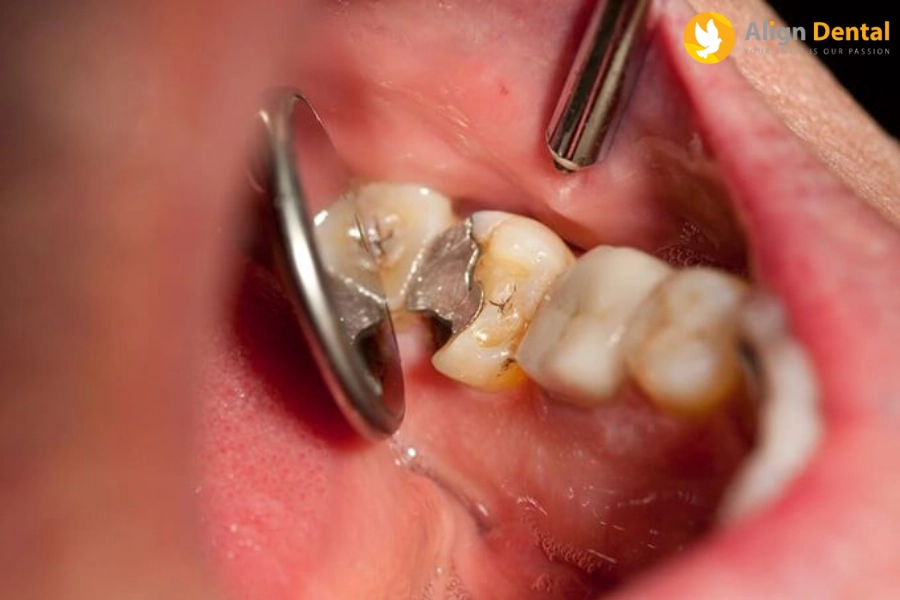 Trồng Răng Hàm Bị Sâu Giá Bao Nhiêu? Khi Nào Nên Trồng Răng Hàm
