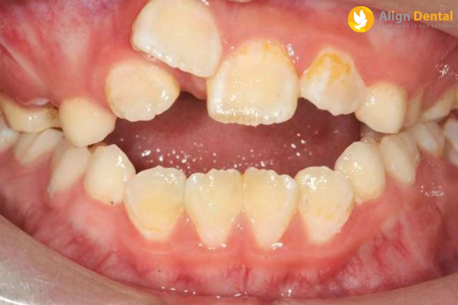 Răng Mọc Lẫy Ở Trẻ Em - Giải Pháp Xử Lý Hoàn Hảo Nhất