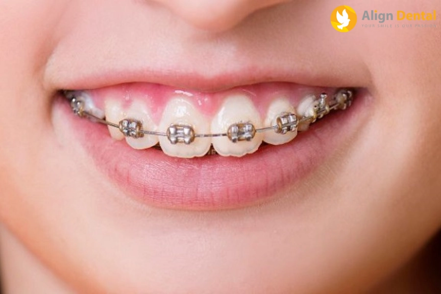 [Báo Giá] Niềng Răng 1 Hàm Cập Nhật Mới Nhất 2023