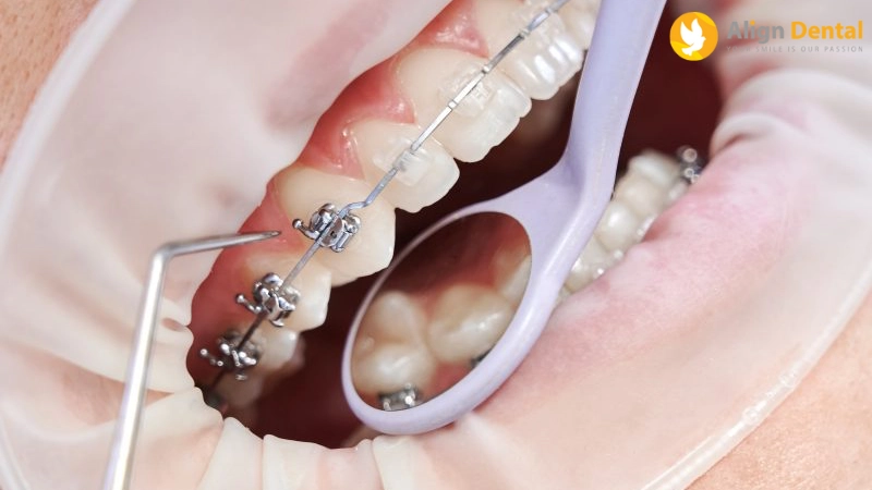 niềng răng bị hóp má