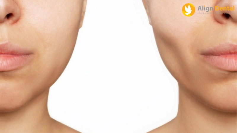niềng răng bị hóp má