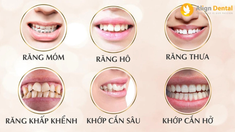 niềng răng trẻ em