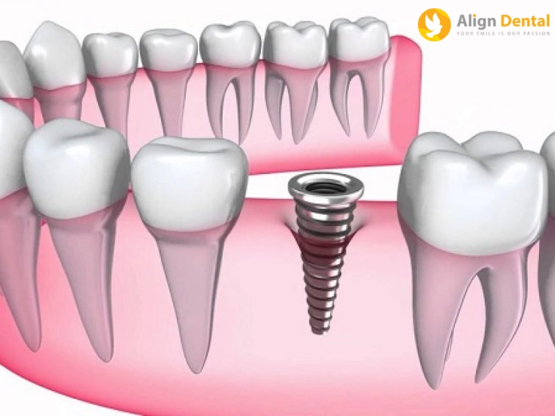 chăm sóc răng sau khi cắm implant
