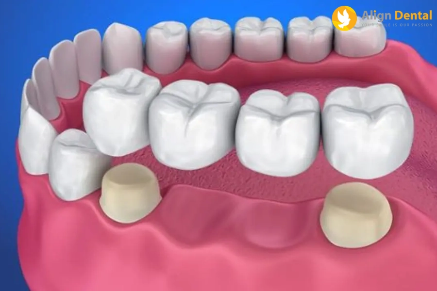 Răng Tạm Trên Implant Là Gì? Có Mấy Loại? Lưu ý cần biết