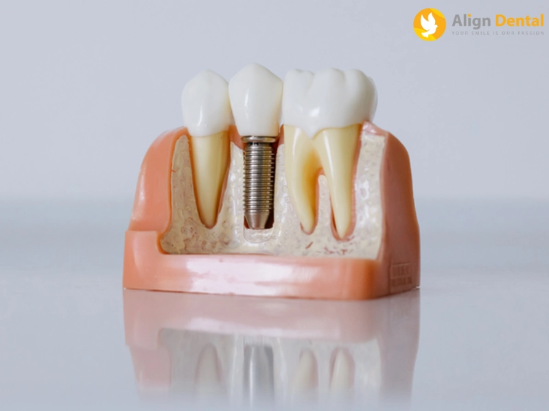 Trụ Implant Hiossen có độ bền và tính thẩm mỹ cao