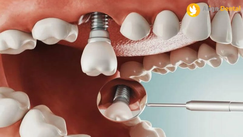 cấy ghép implant xương gò má