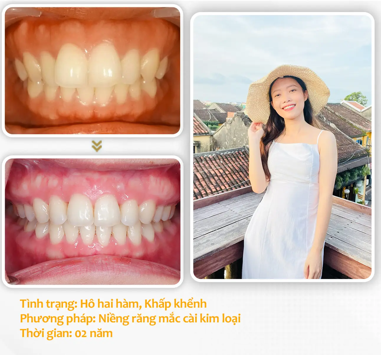 aligndental